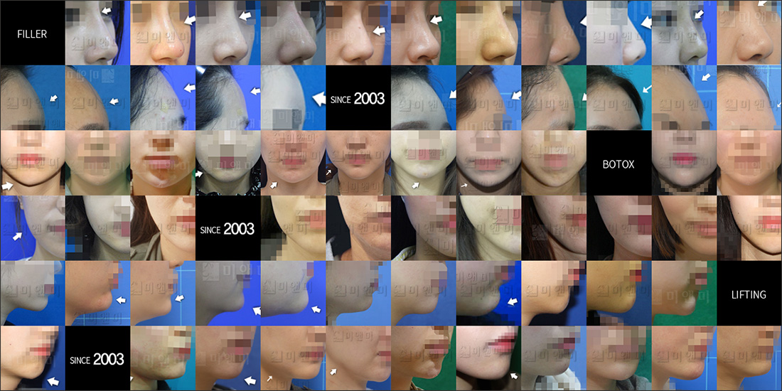 SINCE 2003 MI&MI, 시술후사진모음 일산무턱필러, 정발산역무턱필러, 일산필러, 정발산역필러, 일산코필러, 정발산역코필러, 일산볼필러, 정발산역볼필러, 일산이마필러, 정발산역이마필러, 일산애교필러, 정발산역애교필러, 일산팔자필러, 정발산역팔자필러, 일산입술필러, 정발산역입술필러